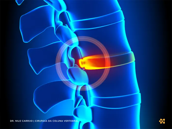 hernia-de-disco-nilo-carrijo-ortopedia-cirurgia-de-coluna-brasilia